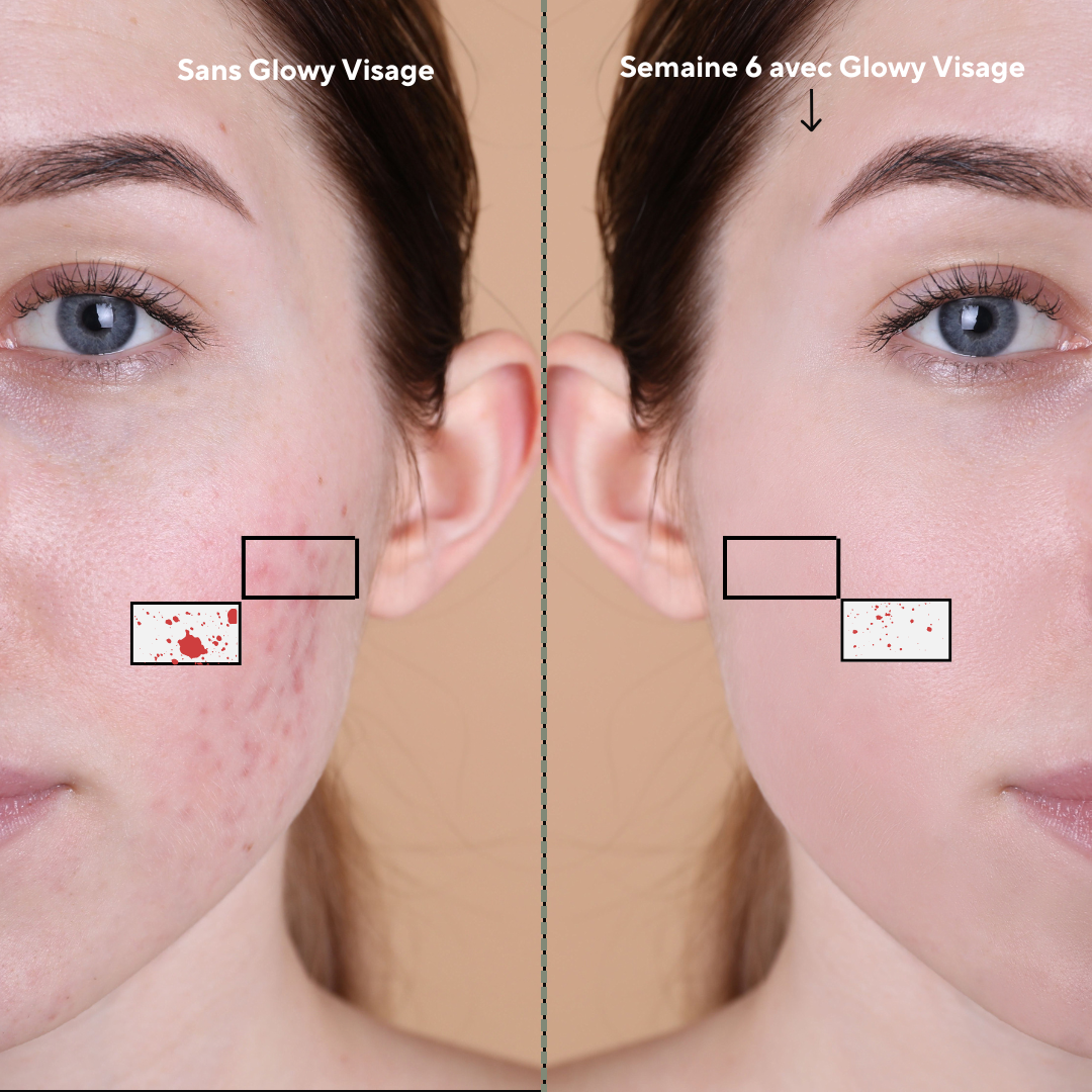 Résultat masque led avant-après.